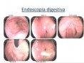 /album/ubicacion-aberrante-de-papila/asenda-papila-bulboduodenal-1-3-jpg/